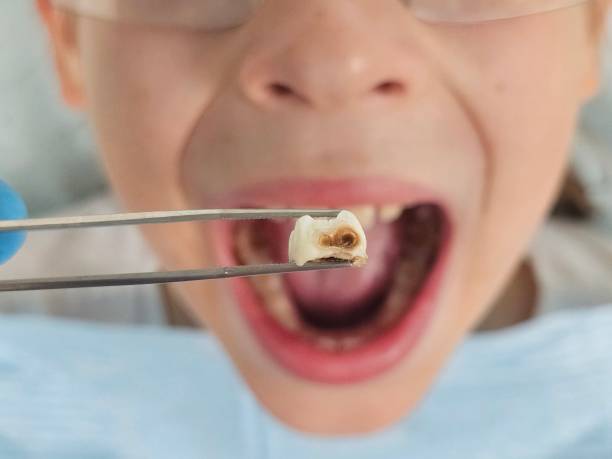 Best Emergency Tooth Extraction in Thruston, KY